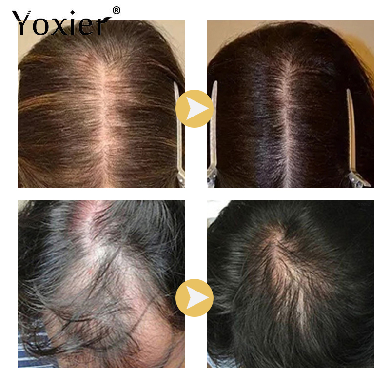 Siero per la crescita intensa  - Hair Care For Hair Loss recensione e prezzo