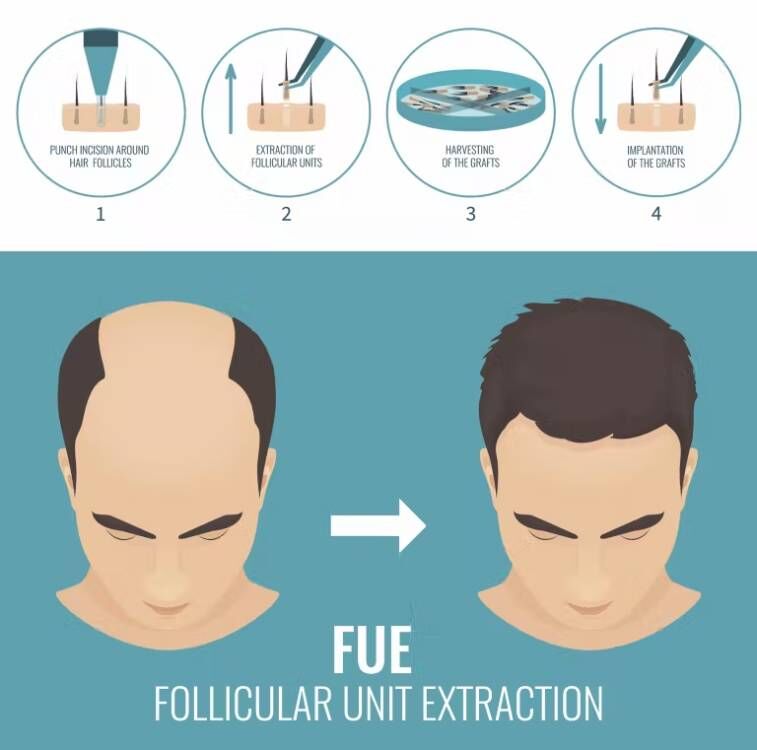 FUE Hair Implant Micro Motor m - Hair Care Basic recensione e prezzo